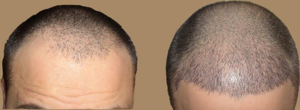 أحدث تقنيات زراعة الشعر