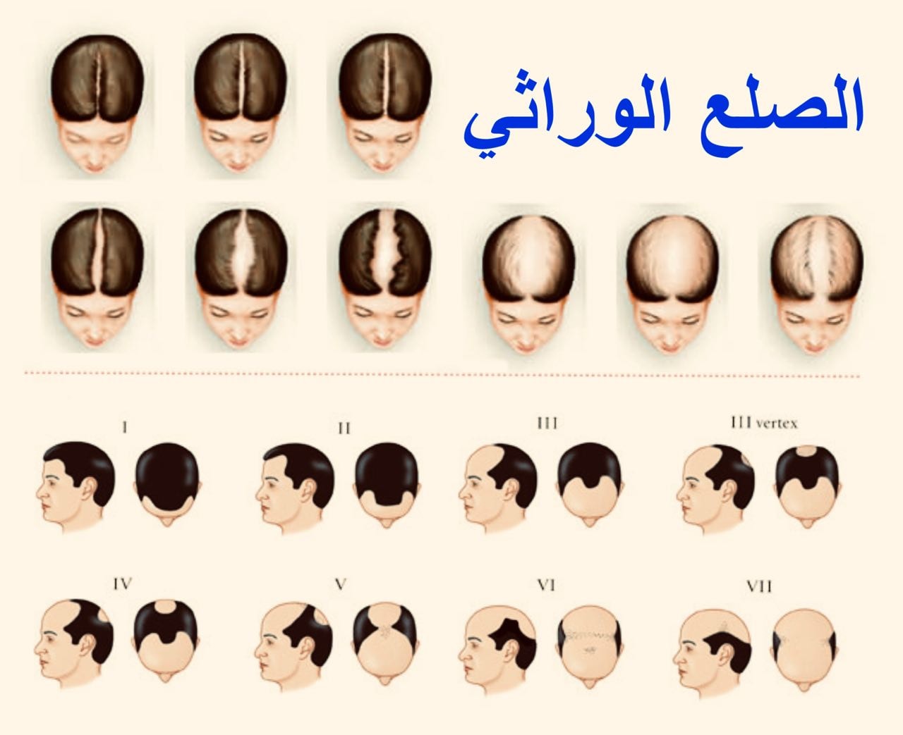 أشكال الصلع الوراثي