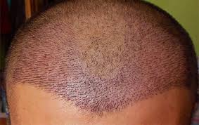زراعة الشعر في مصر